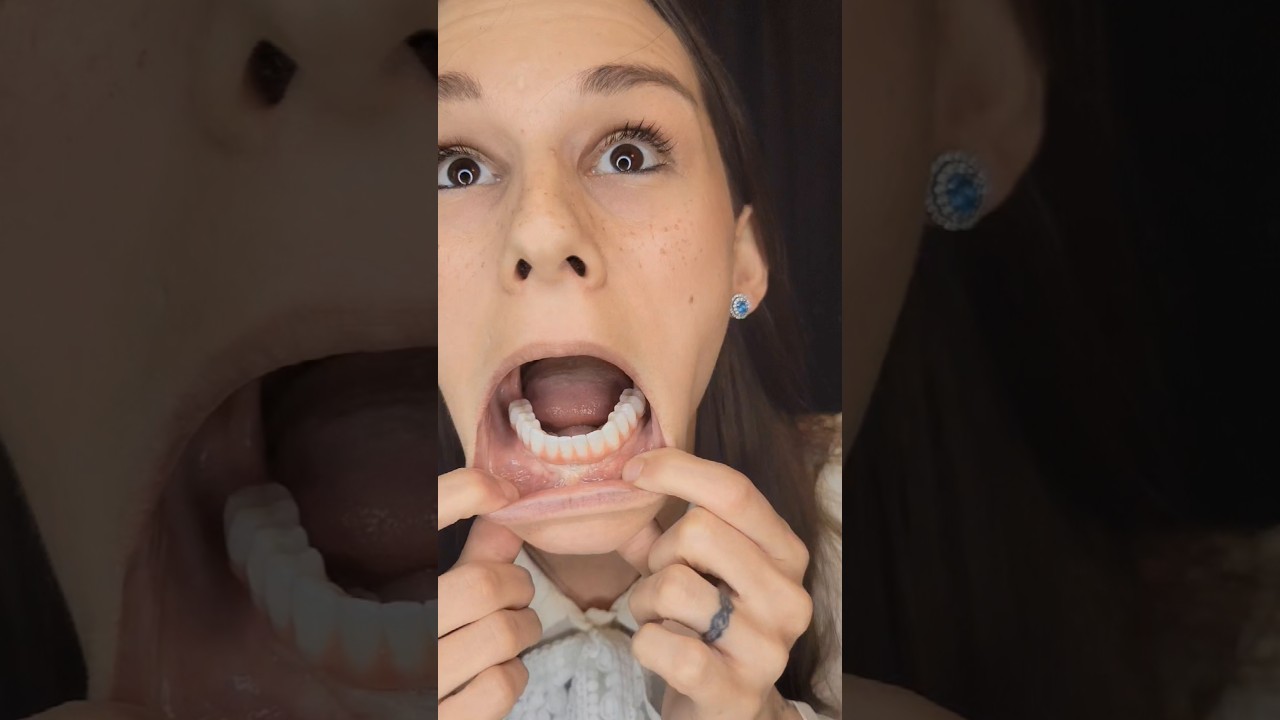 Dental implants arch check - Looking good! ✨️ #teeth #dentalimplants #toothless #dentures