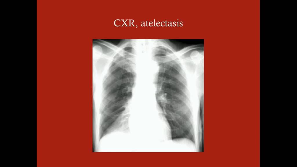 The 5 W's: Wind (Pneumonia/Atelectasis) - CRASH! Medical Review Series