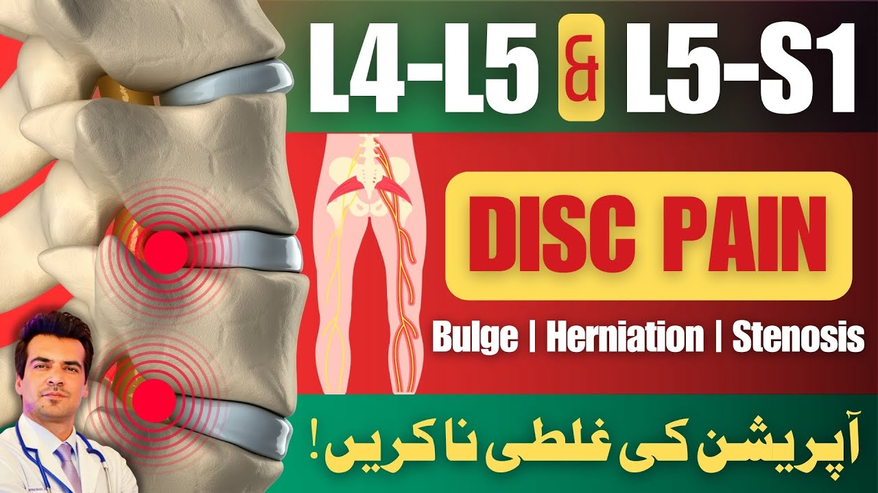 L4-L5 & L5-S1 Disc Bulge Treatment | No Surgery | Home Treatment | Urdu/Hindi