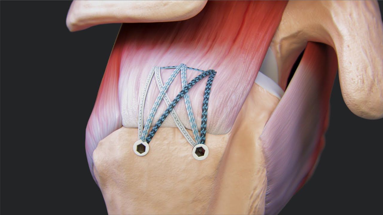 Knotless FiberTak&reg; SpeedBridge&trade; Rotator Cuff Repair With Medial Pulley Ripstop