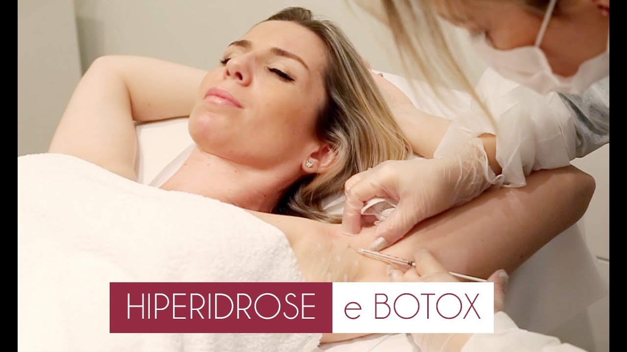 Suor em excesso tratado com botox