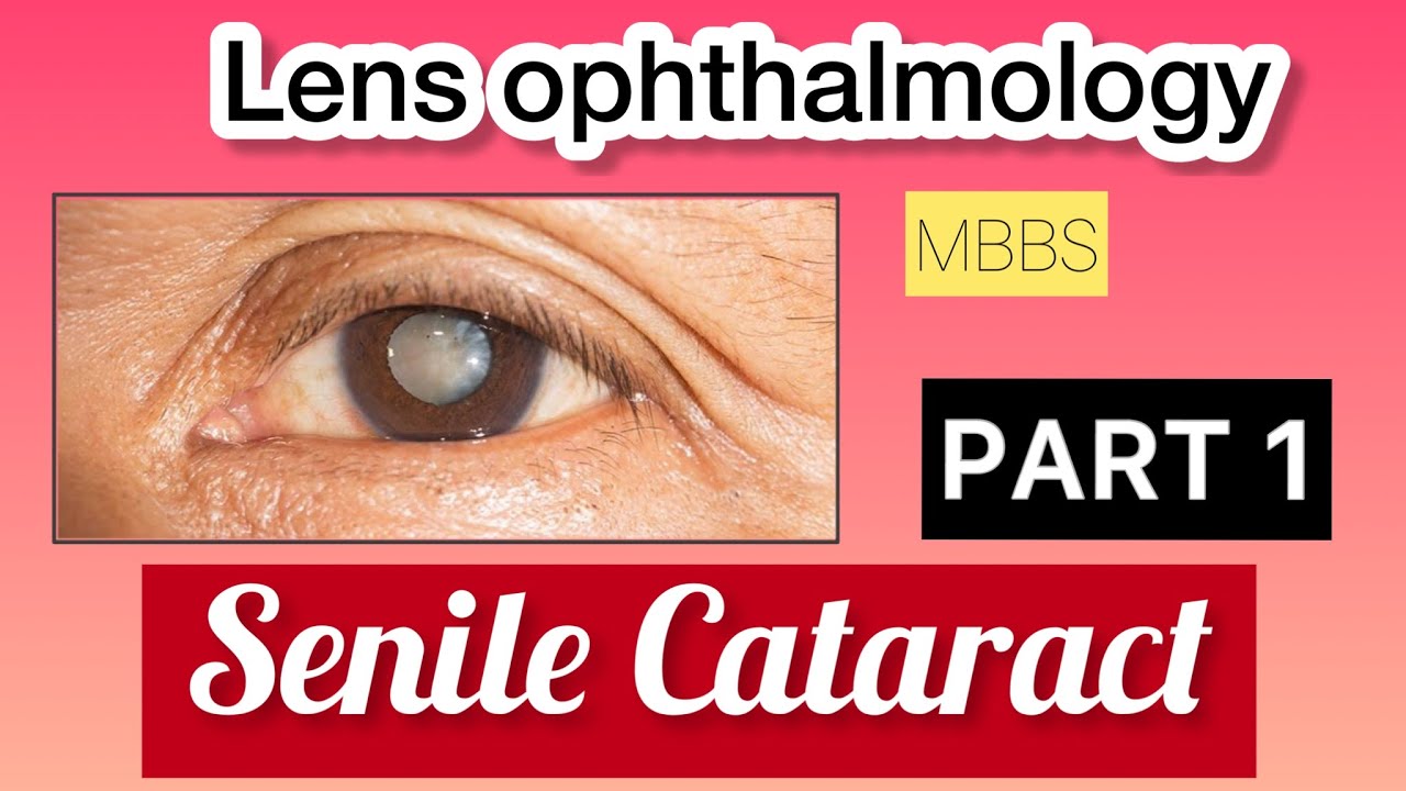 Senile cataract part 1| Types and causes of development | lense ophthalmology