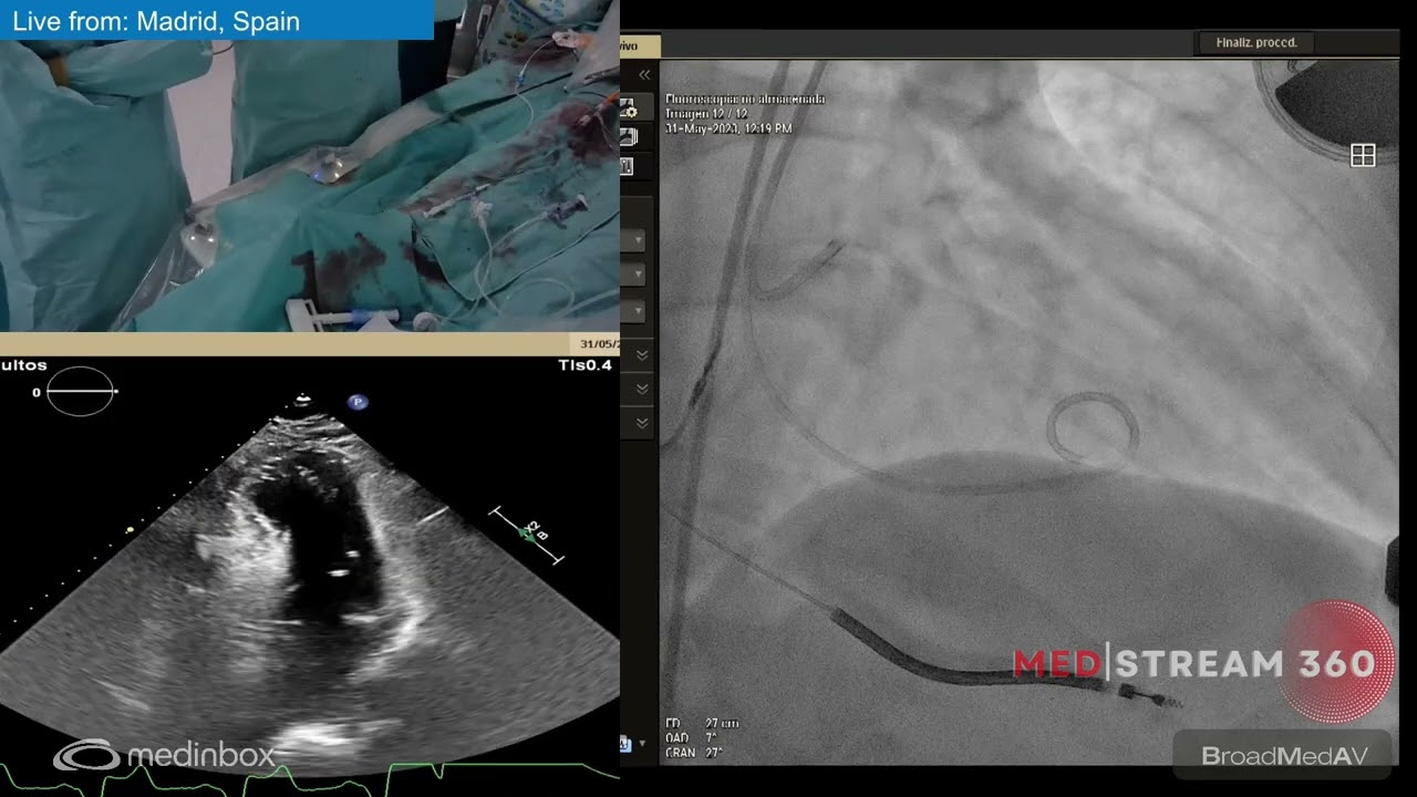 Echocardiography-Guided Alcohol Septal Ablation