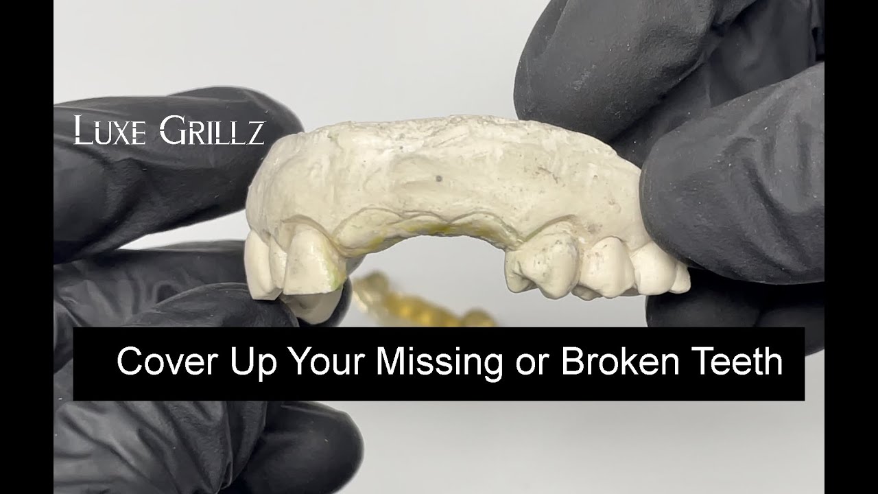 How Do Grillz Fit if I Have Missing Teeth? Luxe Grillz Will Save You Money on Dental Work Today!
