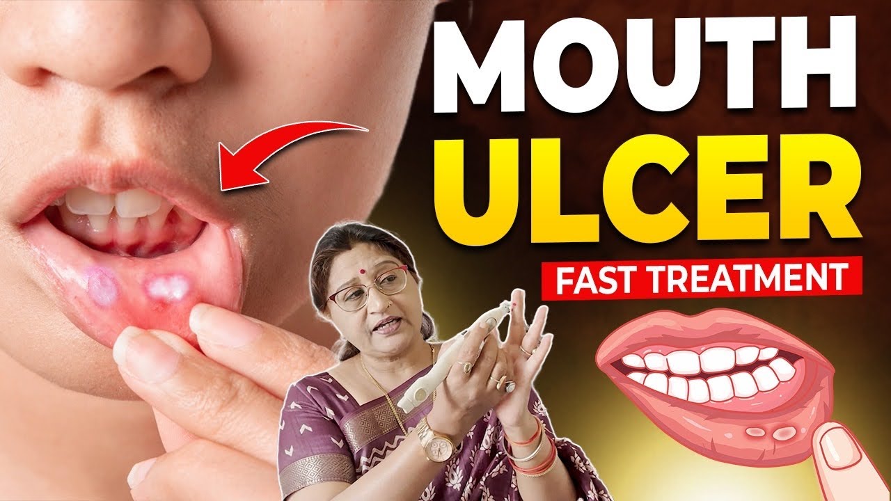 Mouth Ulcer Treatment In Hindi || Acupressure For Mouth Ulcers || मुंह में छाले का घरेलू उपचार