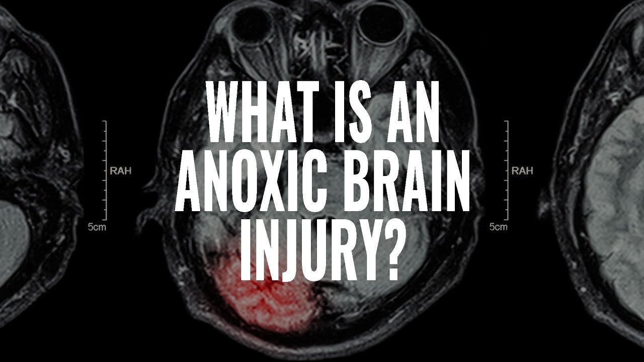 What is an Anoxic Traumatic Brain Injury? I The McCraw Law Group