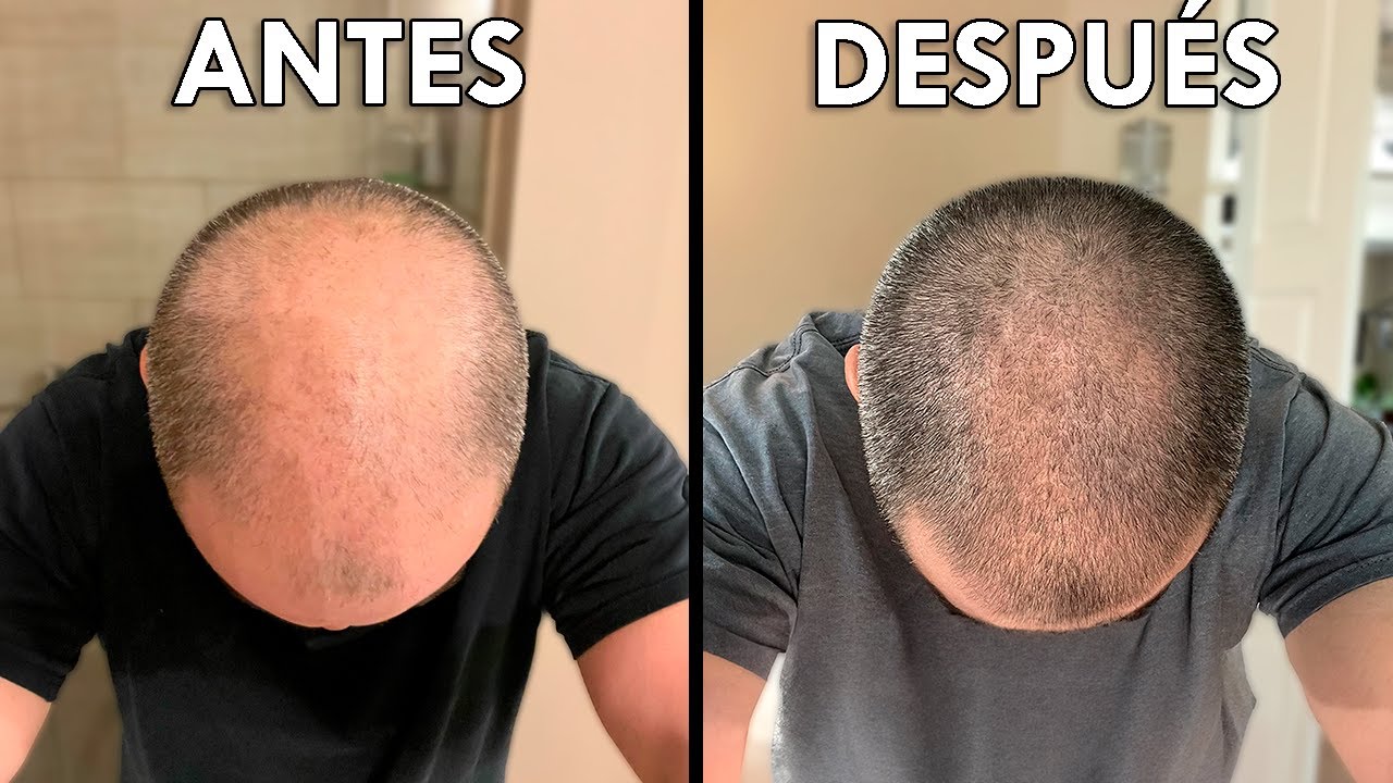 Pirilutamida ¿El Secreto Para Recuperar El Pelo Sin Pastillas?