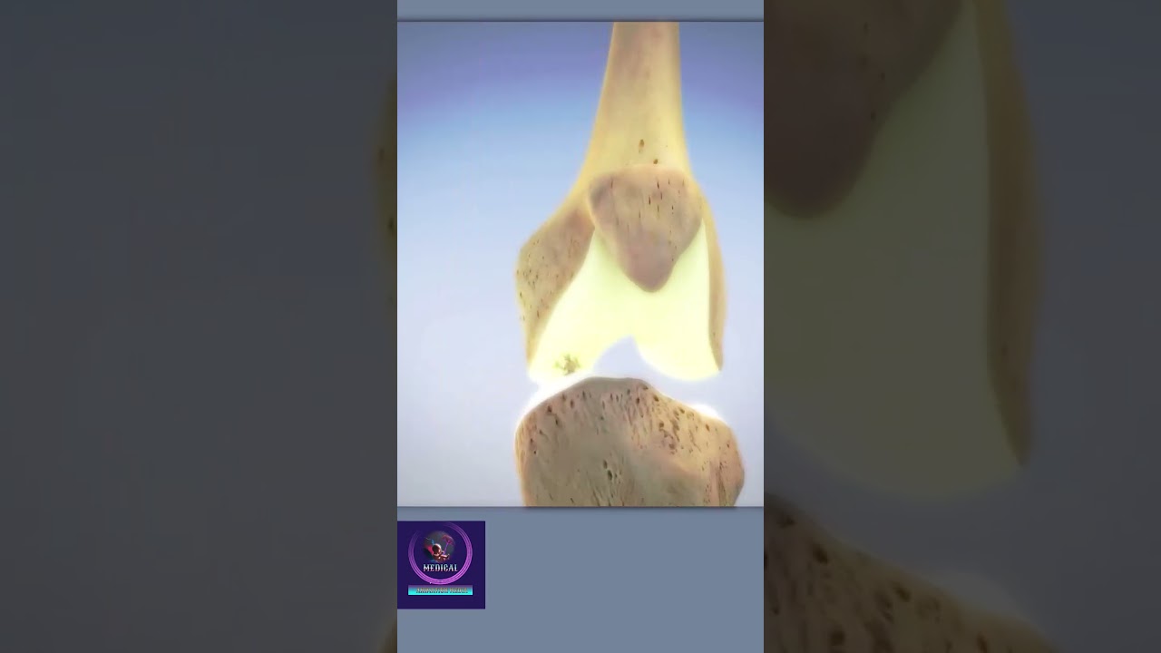 Knee Microfracture Surgery #shorts