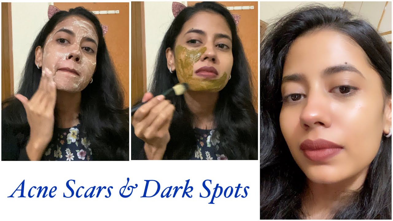 Remove Acne Scars, Dark Spots and Discoloration Naturally with this Routine
