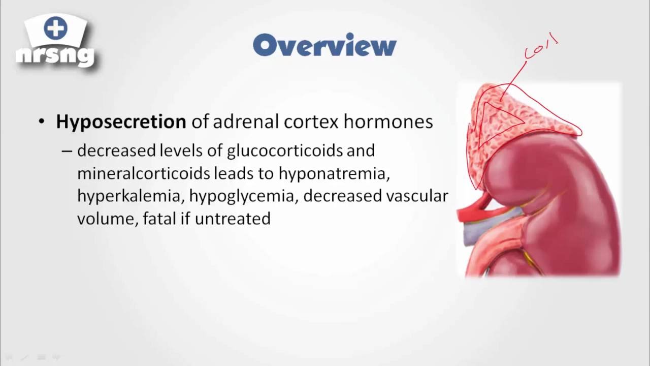Addison's Disease NCLEX&reg; Review | NRSNGacademy.com