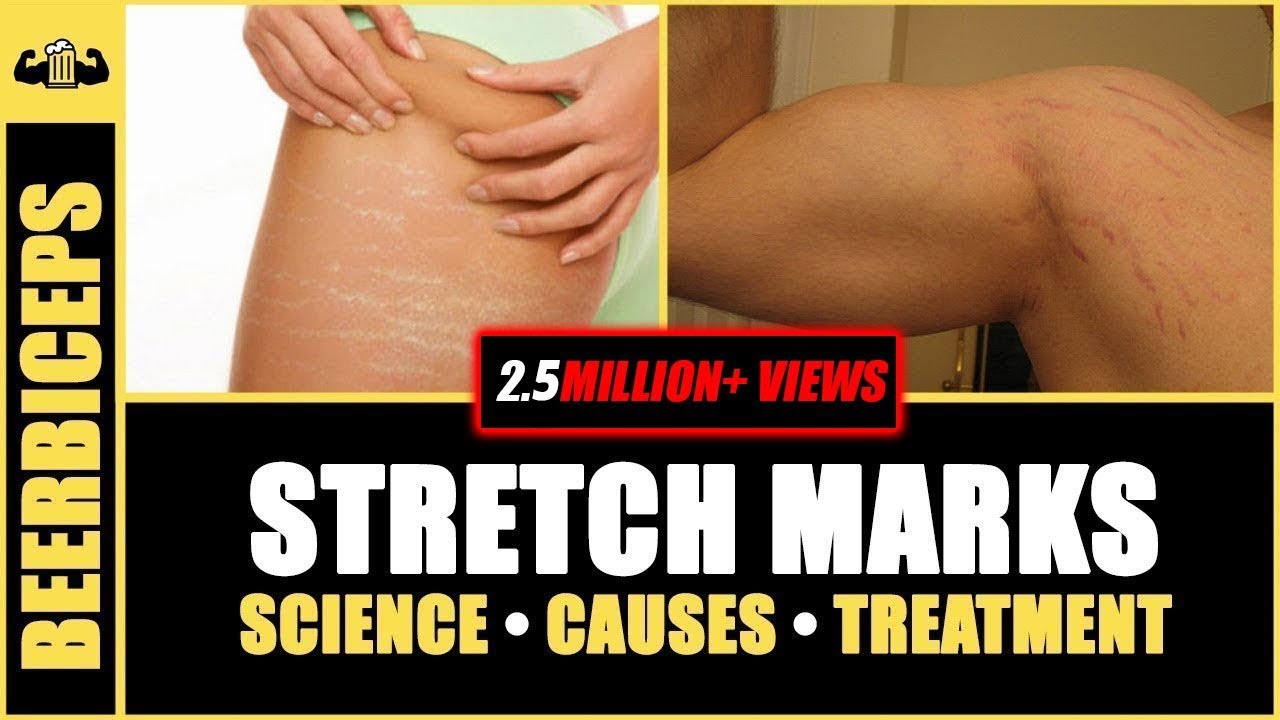 GOODBYE FOREVER - Stretch Marks | Stretch Marks Science, Causes & Treatment | BeerBiceps