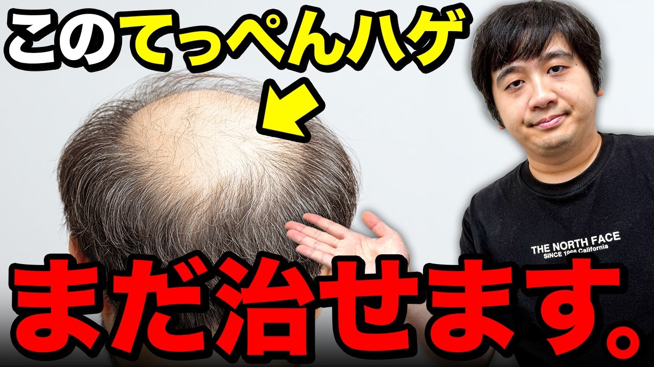 【手遅れになる前に】てっぺんハゲの薄毛治療はこれで解決！どうやって治療する？【AGA】