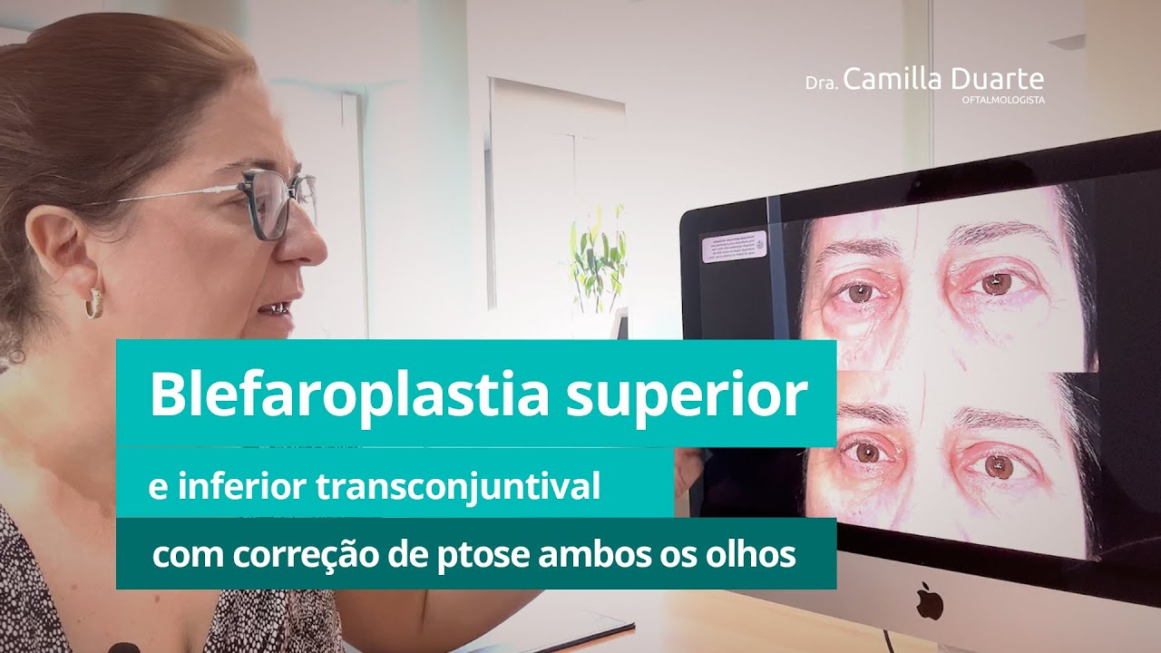 Blefaroplastia superior e inferior transconjuntival com correção de ptose