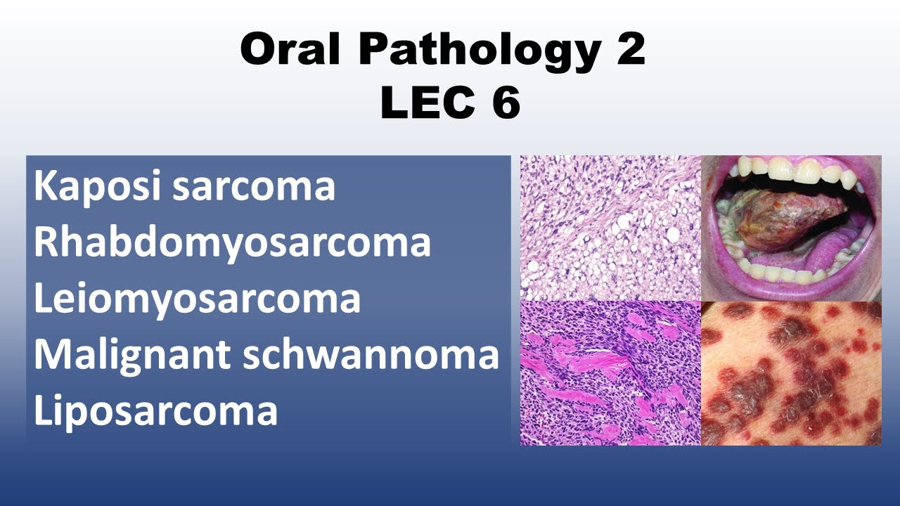 Oral Pathology 2 - LEC 6 - (Kaposi sarcoma - Rhabdomyosarcoma - Leiomyosarcoma)