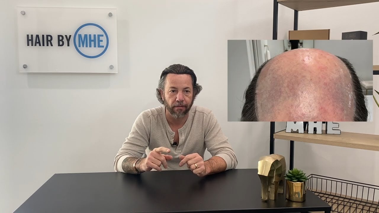 Using Tape On Your Hair Replacement Or Hair System