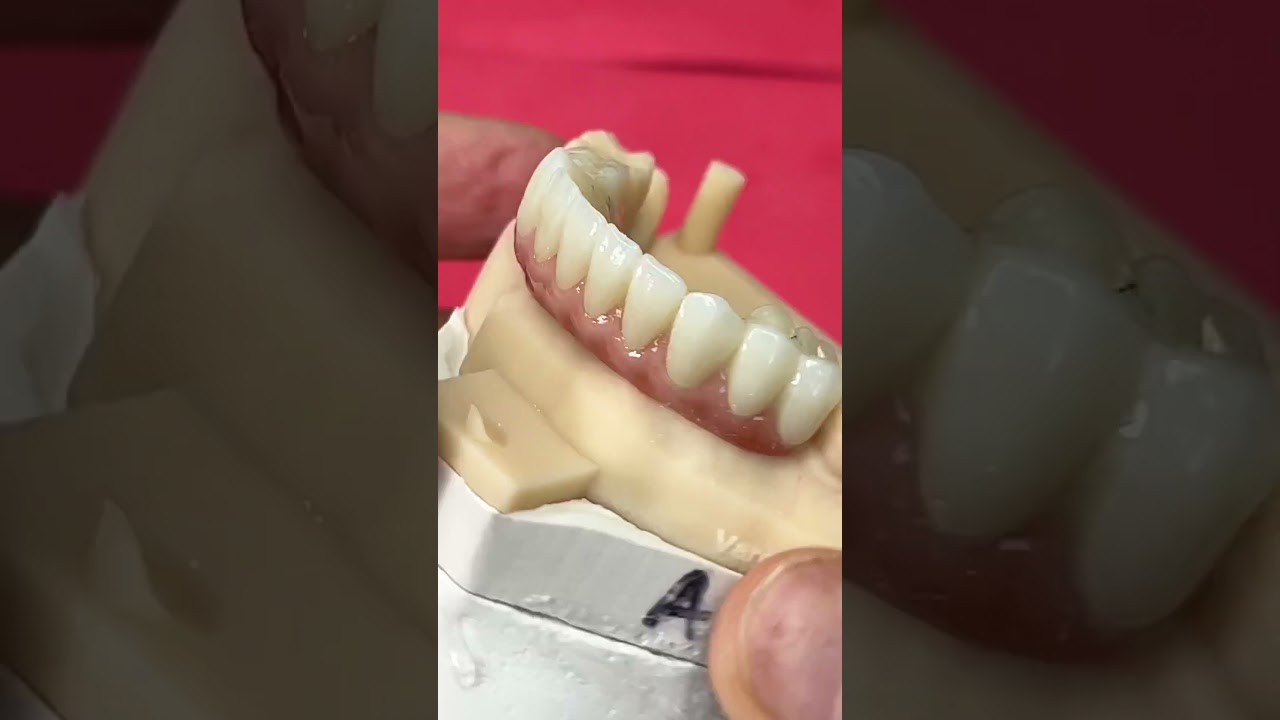 All-On-4 Zirconia with no Ti-Base @EnvisiontecMain #envisiontec