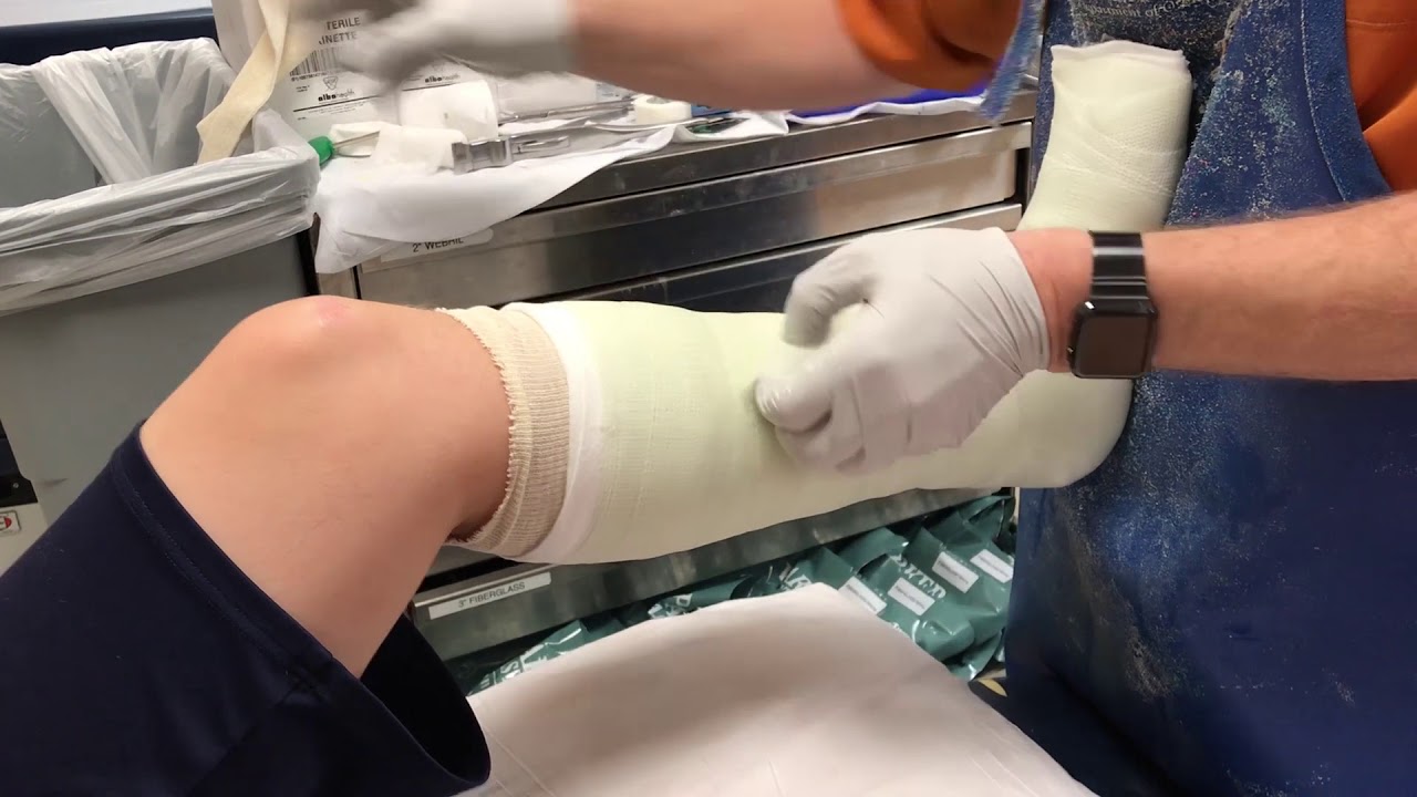 Ever Wonder How They Put a Cast on a Leg?
