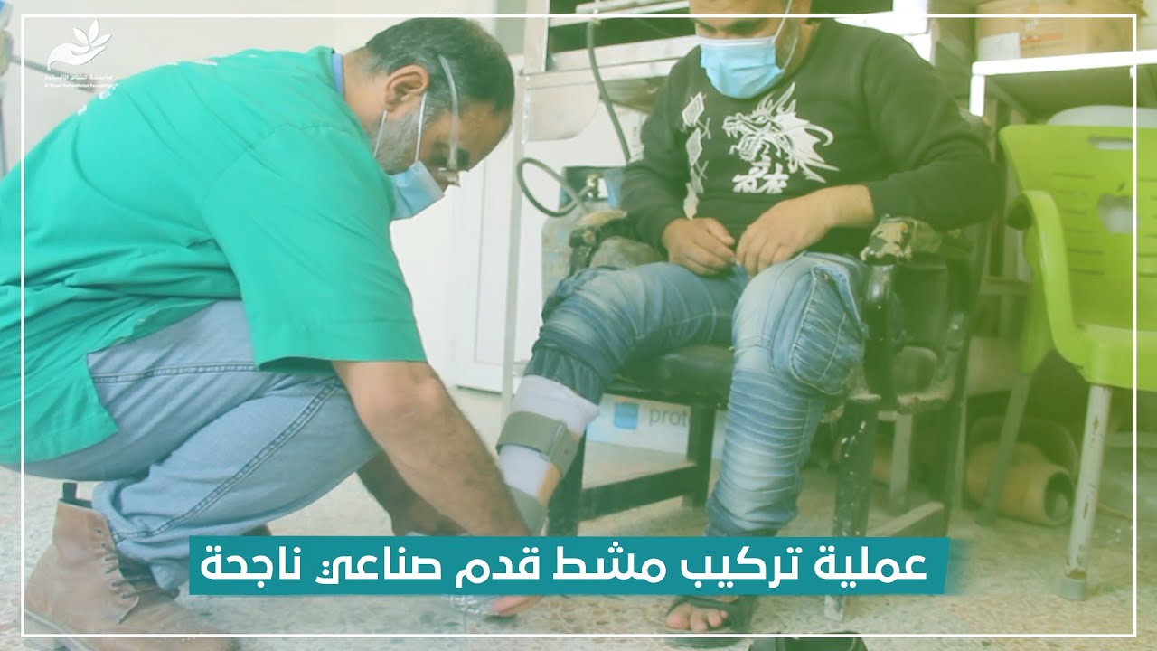 عملية تركيب مشط قدم صناعي ناجحة لمريض في مركز الشام لإعادة التأهيل في تل الكرامة شمال إدلب