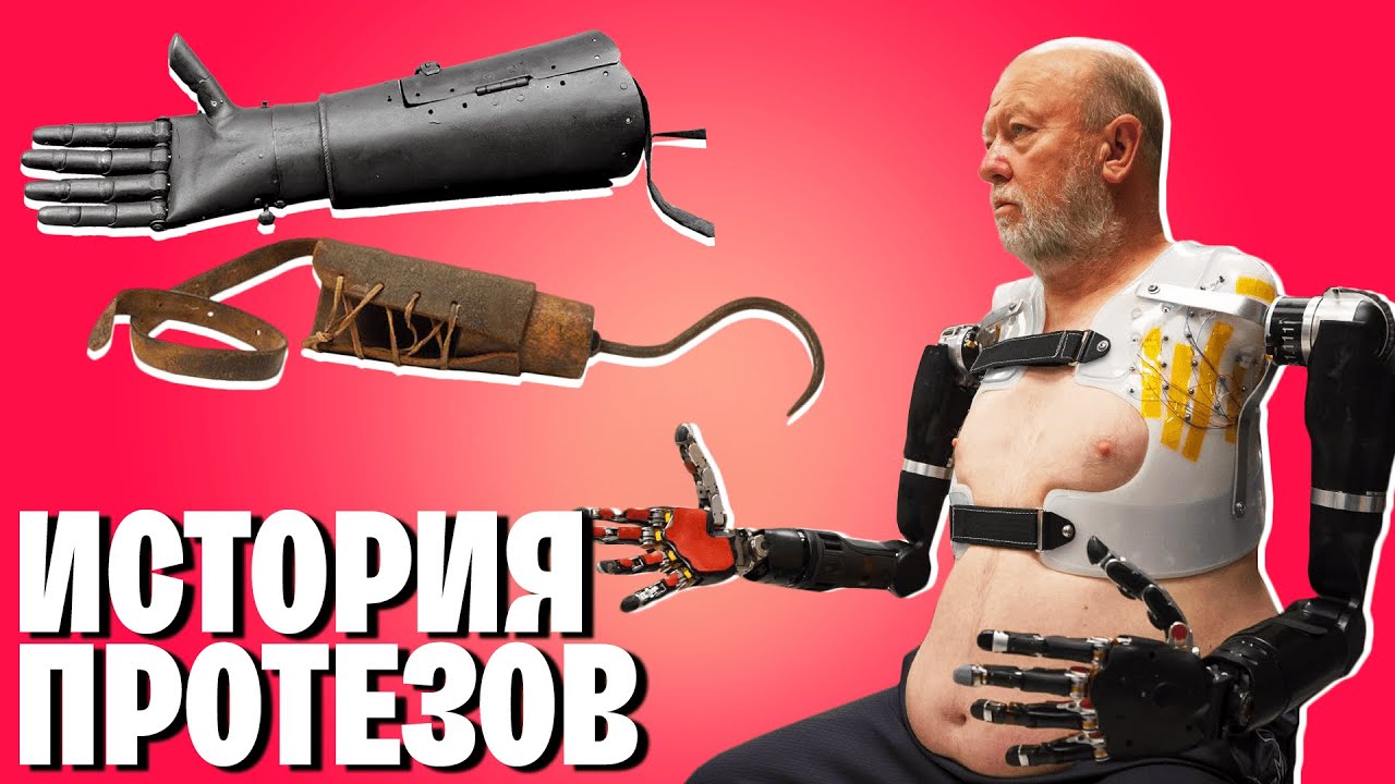 Современные чудеса медицины: История протезирования, которая удивит даже врачей | WAS