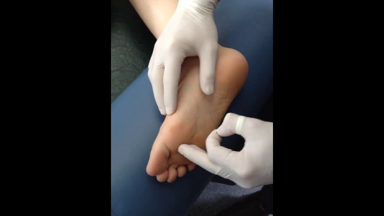 Flexor Hallucis Brevis Dry Needling