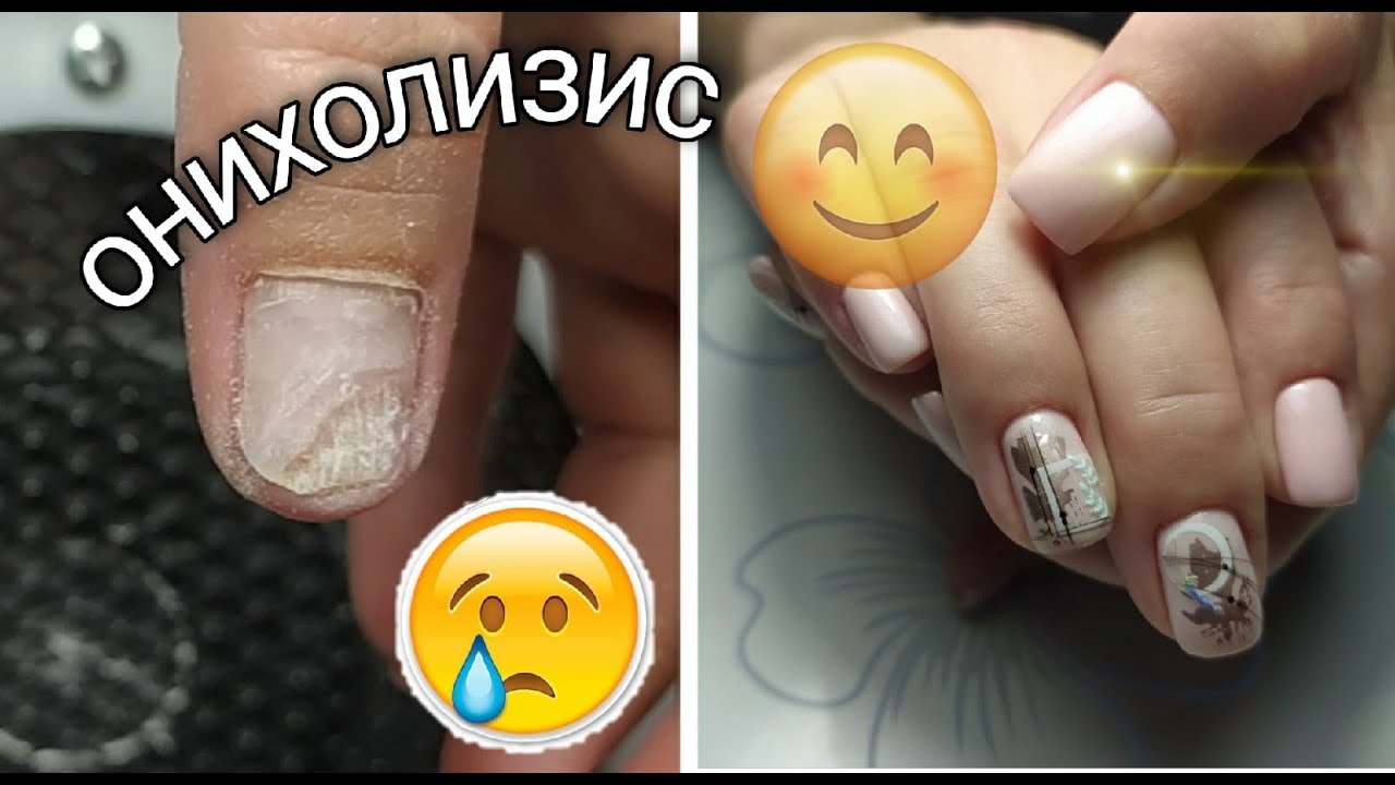 Онихолизис😲Зачистка и протезирование