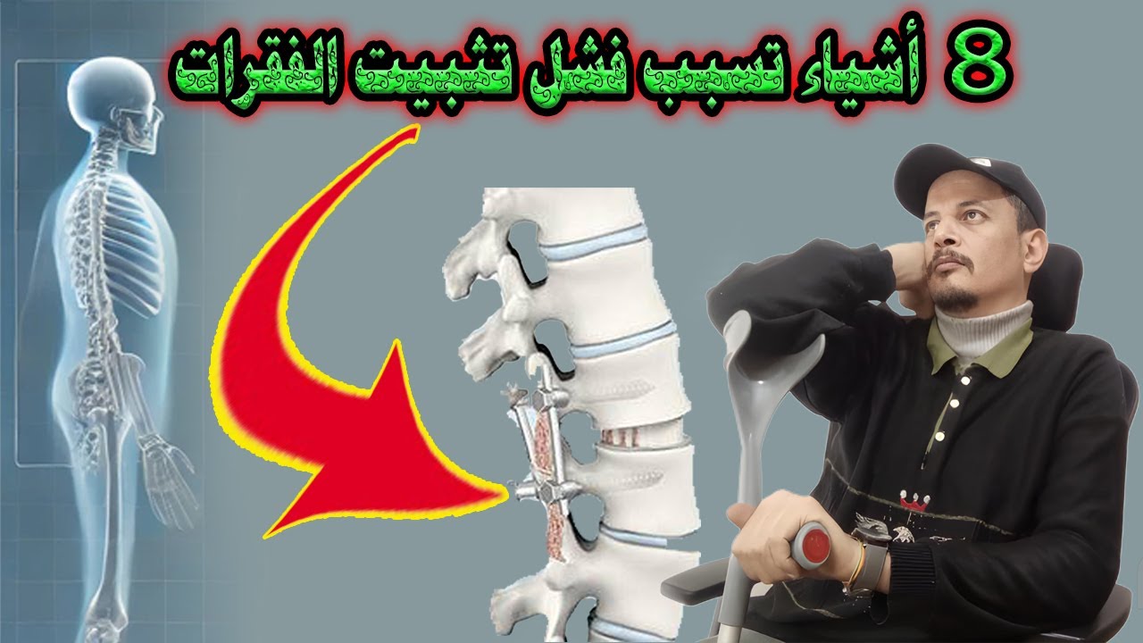 أهم 8 أشياء تتسبب فى فشل عملية تثبيت الفقرات
