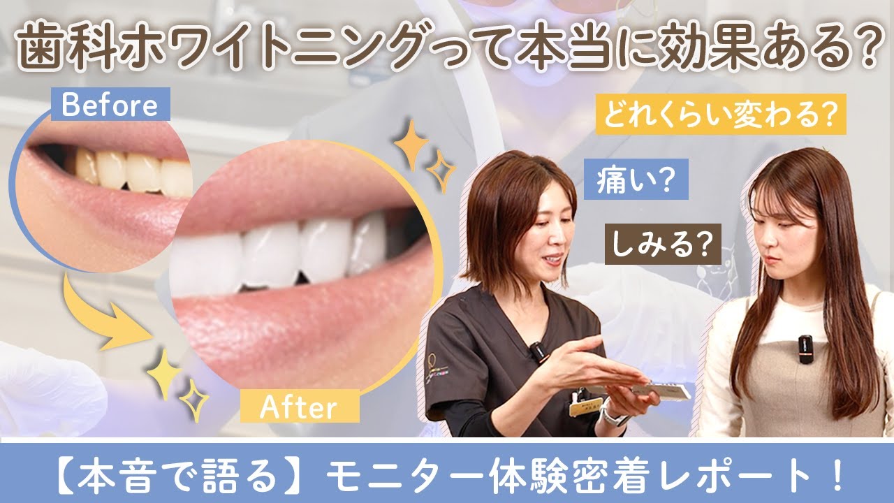 【歯が白くなる感動体験】苅安賀で話題のホワイトニングを一般女性が体験してみた