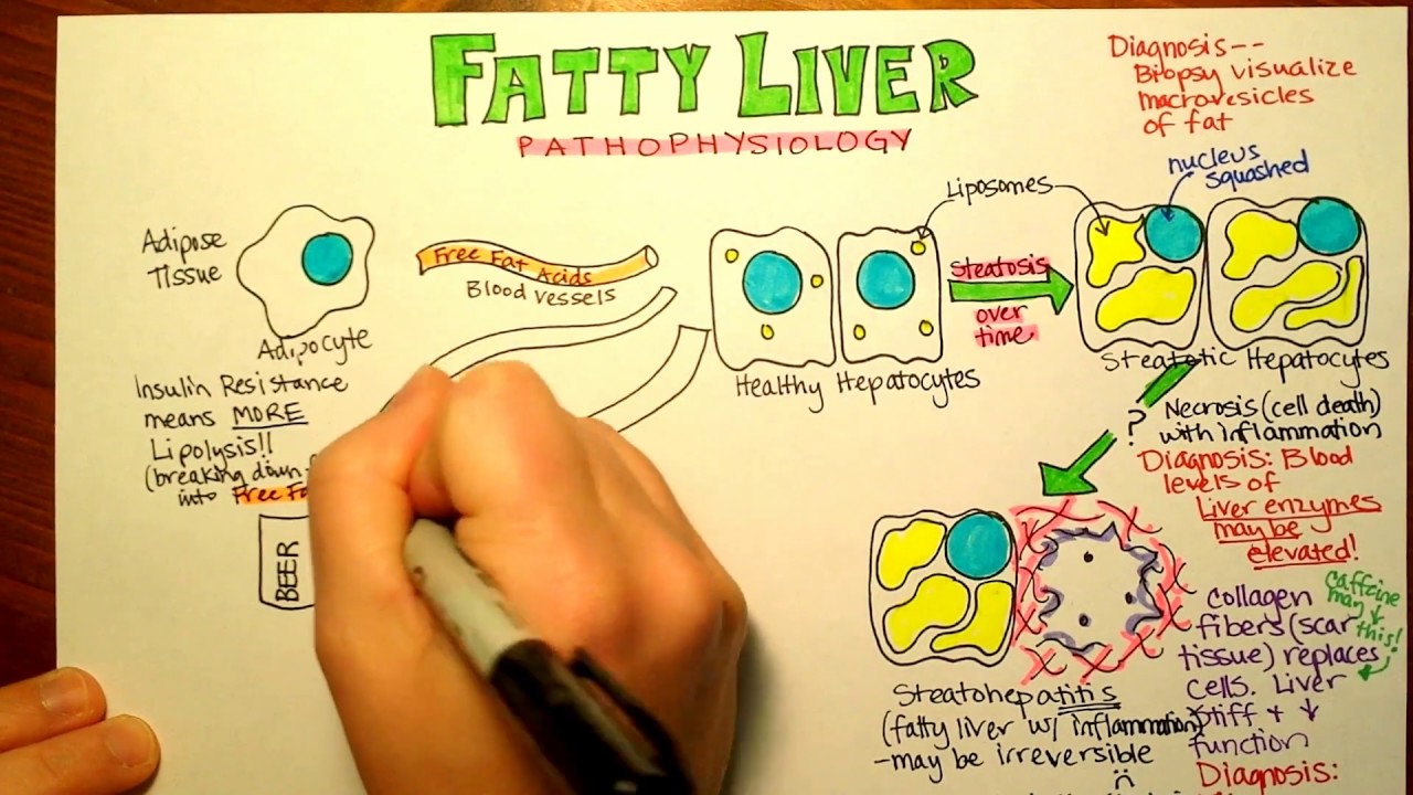 Fatty Liver Pathophysiology