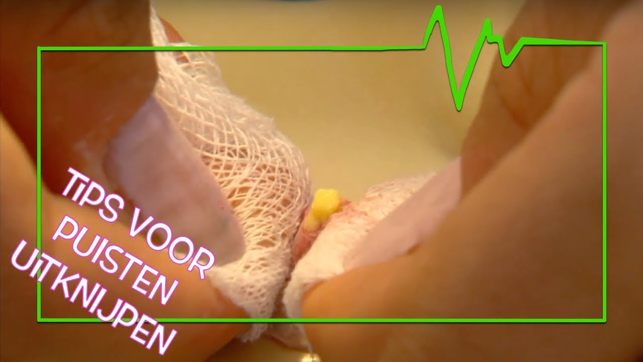 PUISTEN GOED UITKNIJPEN (TIPS!) - TOPDOKS SPECIALISME