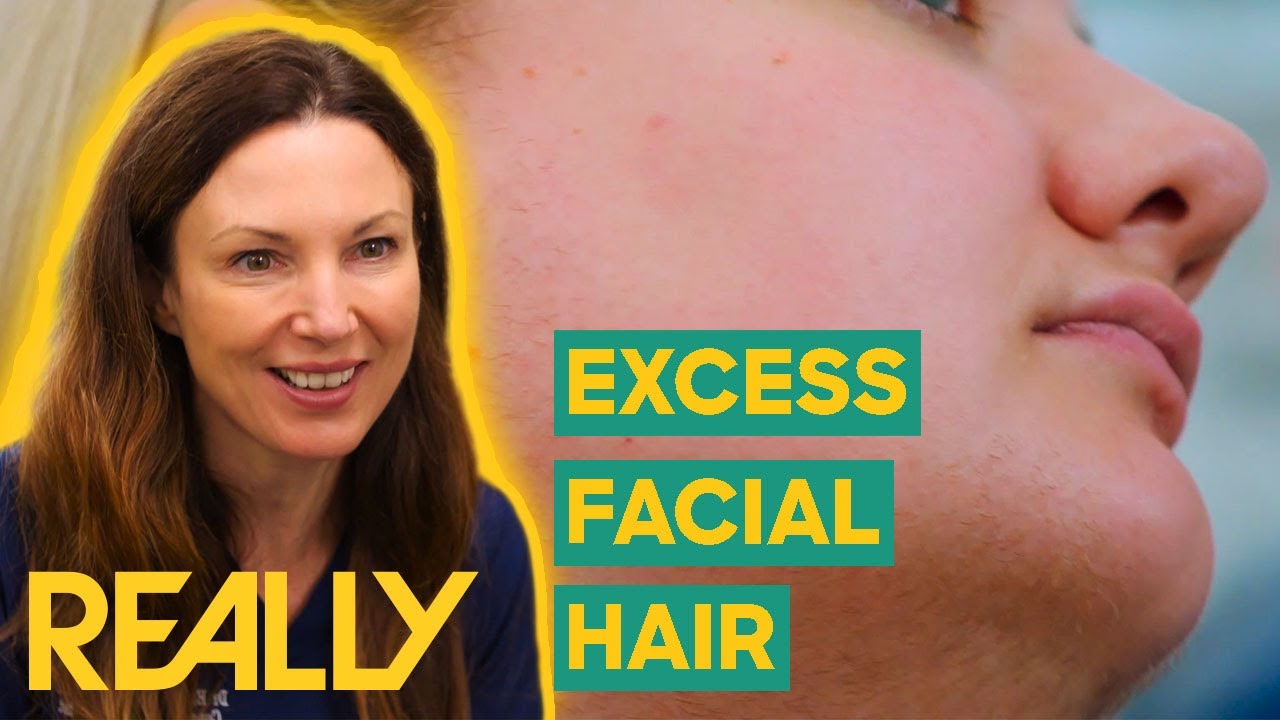 Woman Is "Embarrassed" Of Her Excess Hair Growth & Needs Dr. Emma's Help | The Bad Skin Clinic