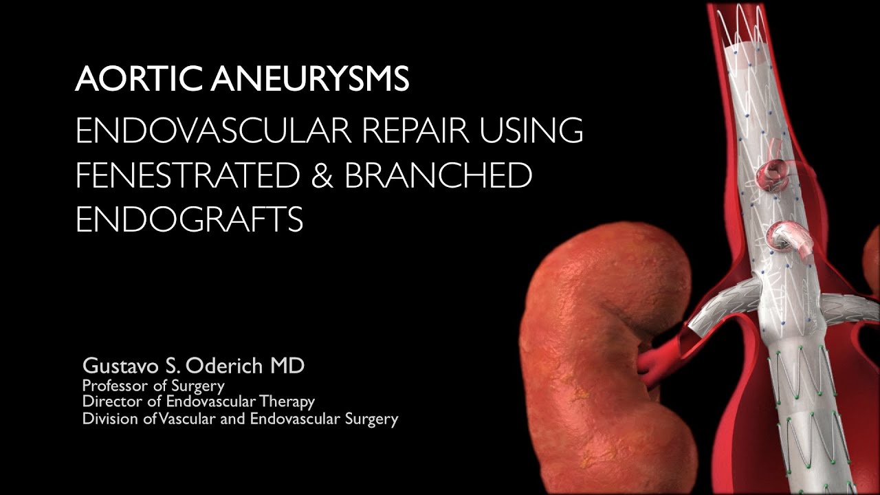 Aortic aneurysm treatment with endovascular fenestrated and branched stent-grafts