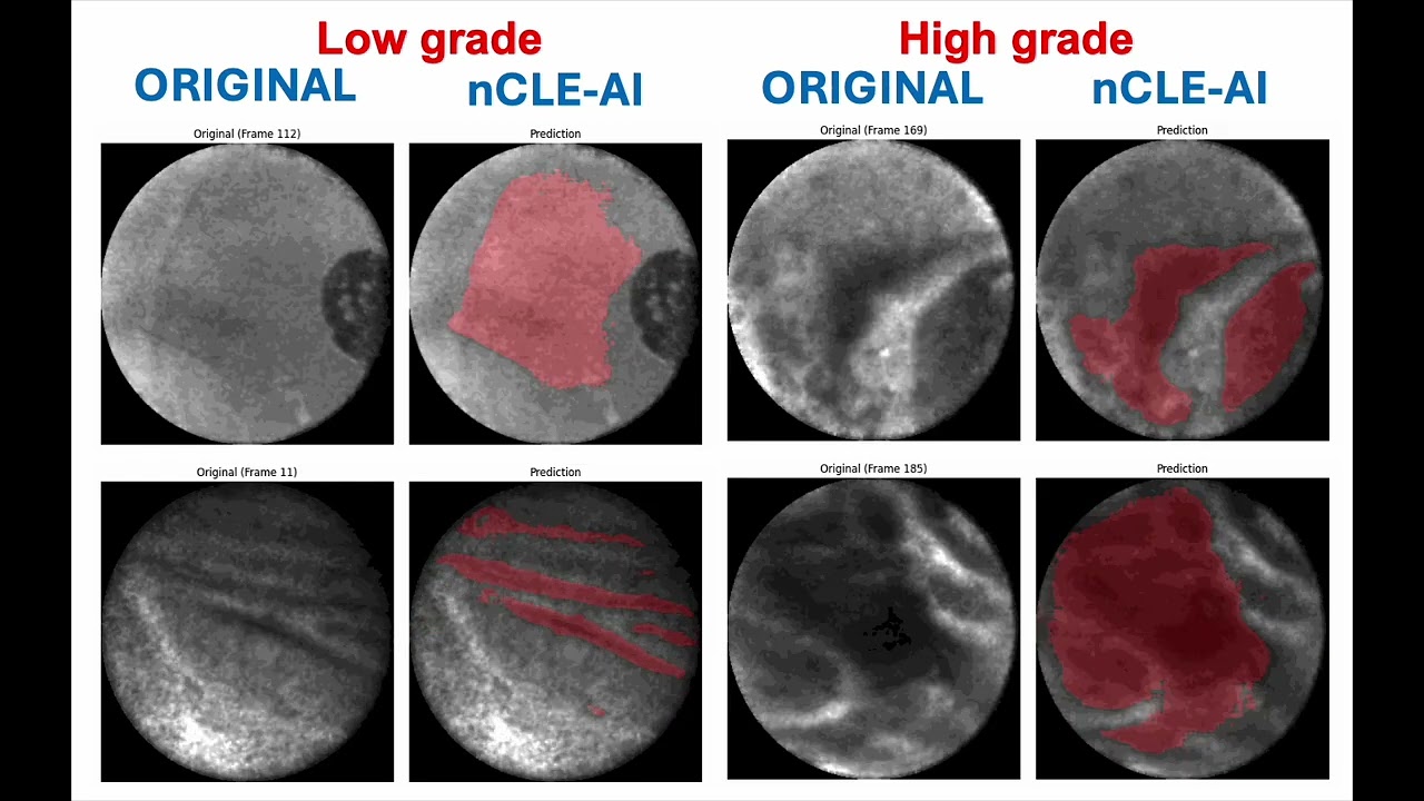 Endomicroscopy (nCLE) - AI algorithm