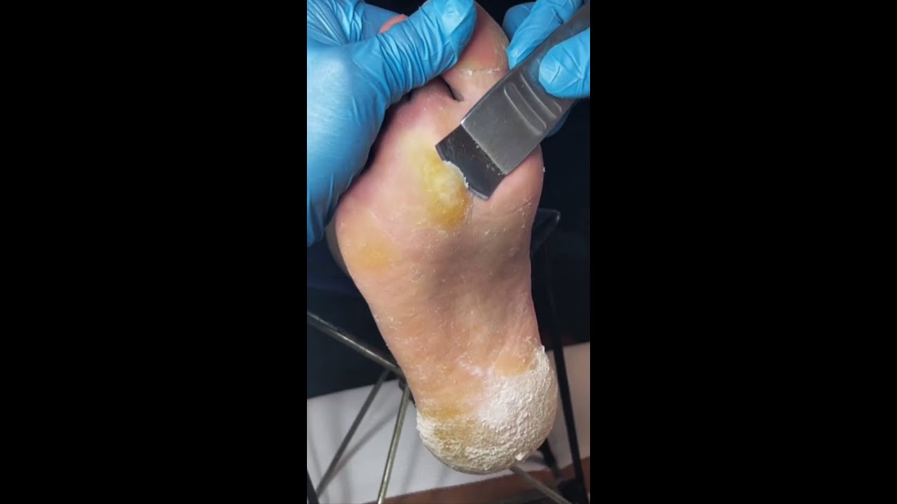 Soothing Foot Care: Gentle Corn Removal Process@LotusWellness-Pedicure