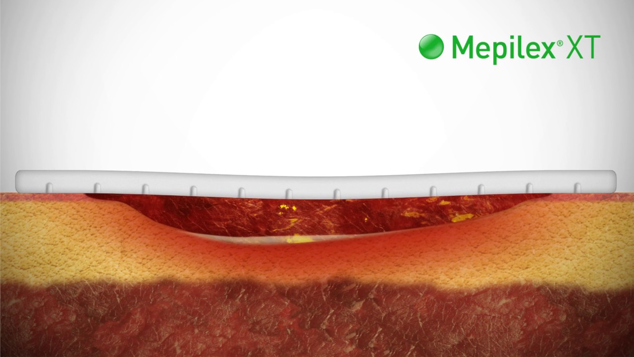 Molnlycke Mepilex XT Foam Dressing With Safetac Technology