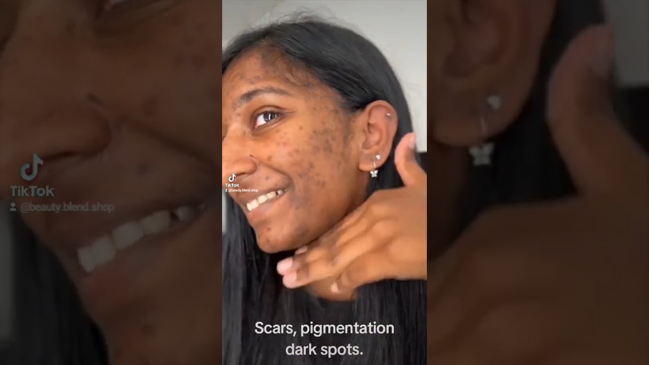 Extreme👉🏻 condition of acne and scars review ✨of la roche posay skin care kit 🧖&zwj;♀️✨