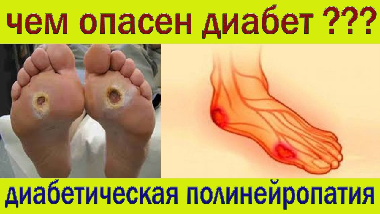 Диабетическая полинейропатия. О чем молчат эндокринологи???