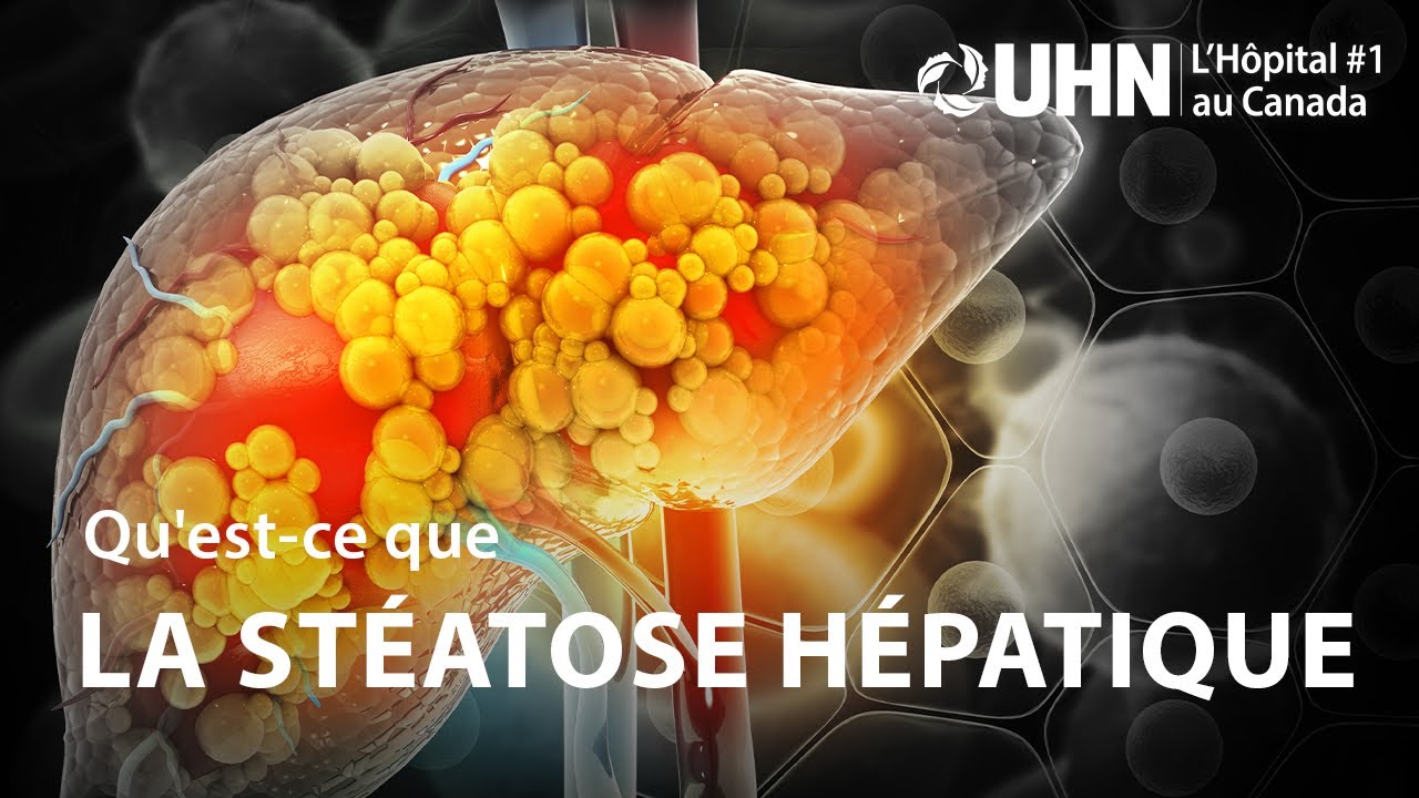 L'UHN Explique : La stéatose hépatique | UHN Explains: Fatty Liver Disease