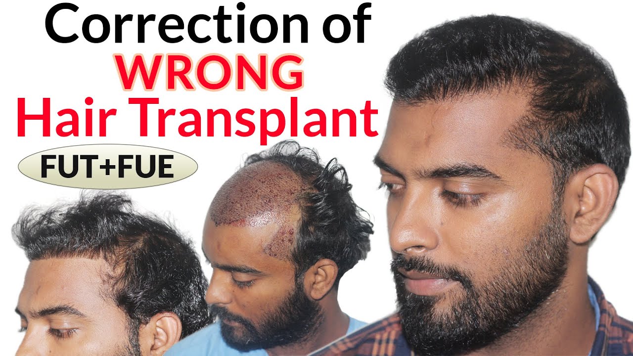 How WRONG Hair Transplant Correction in India is performed | Medispa Jaipur Hair Transplant | Delhi