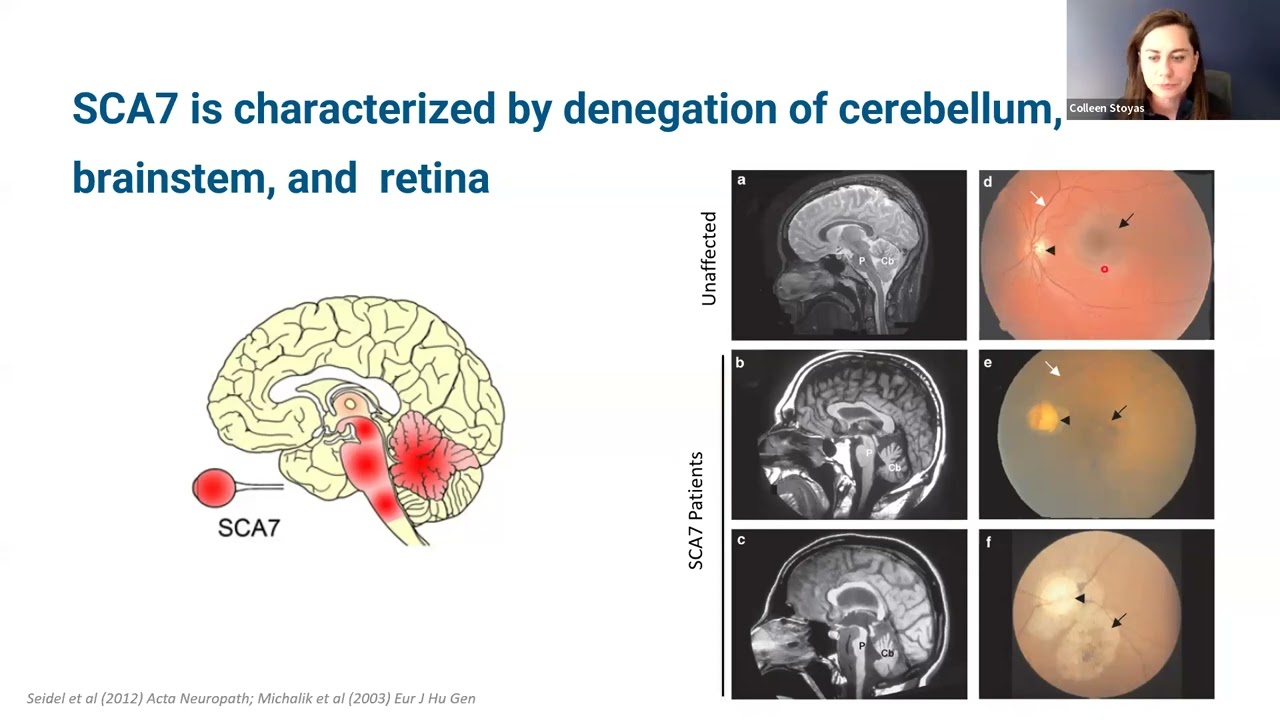Research and Treatment Development for SCA7
