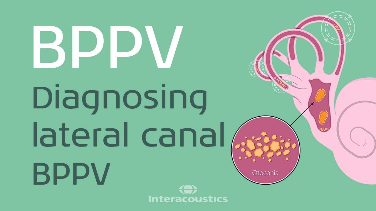 How to Diagnose Lateral Canal BPPV
