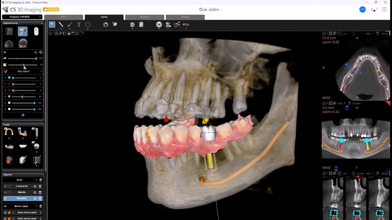CS 3D Imaging Premium: Acelera tu flujo de trabajo para la planificación de implantes con IA