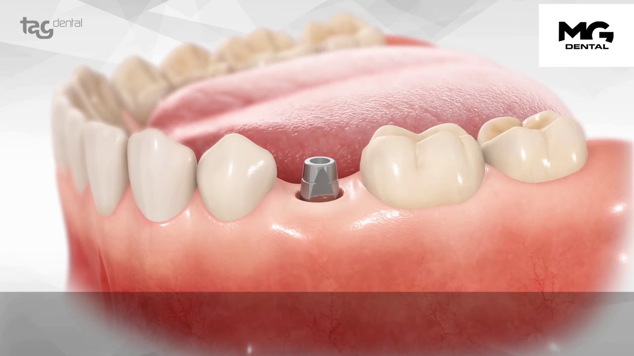 TAG İMPLANT - &Uuml;st Yapı ve Protez Tasarımı