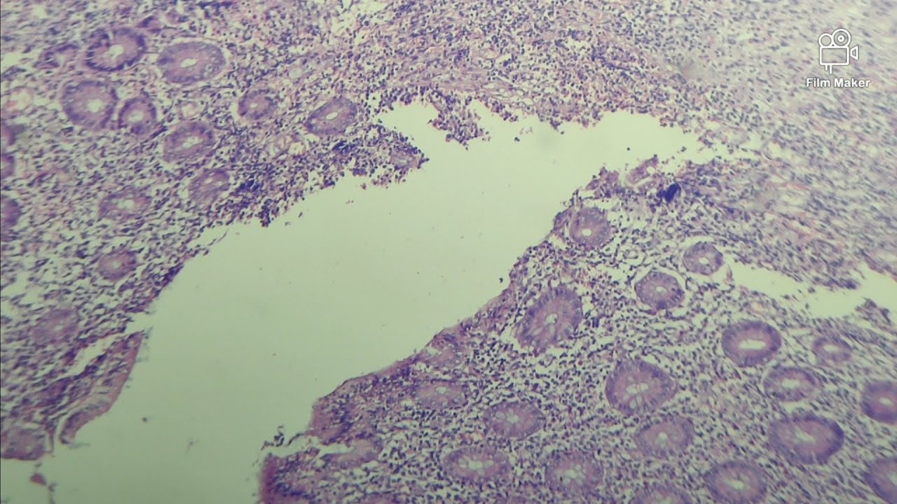 Appendicitis - Histopathology slides