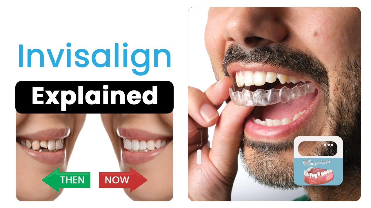 Invisalign on Teeth Talk with Dr Swati Maan