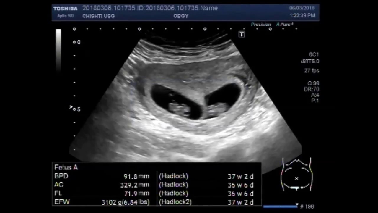 Ultrasound Video showing scan of an early twin pregnancy.