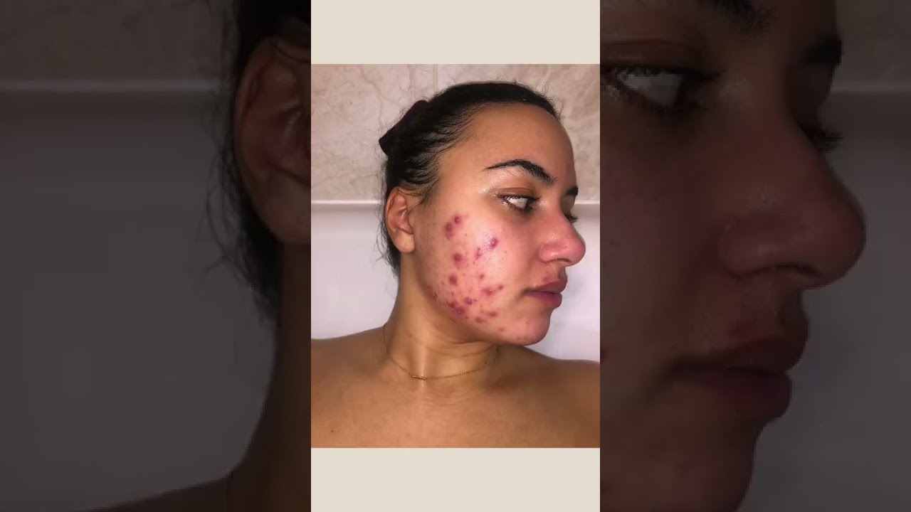 12 Weeks Differin cream 0.1%  Doxycycline 100mg for hormonal acne results #shorts