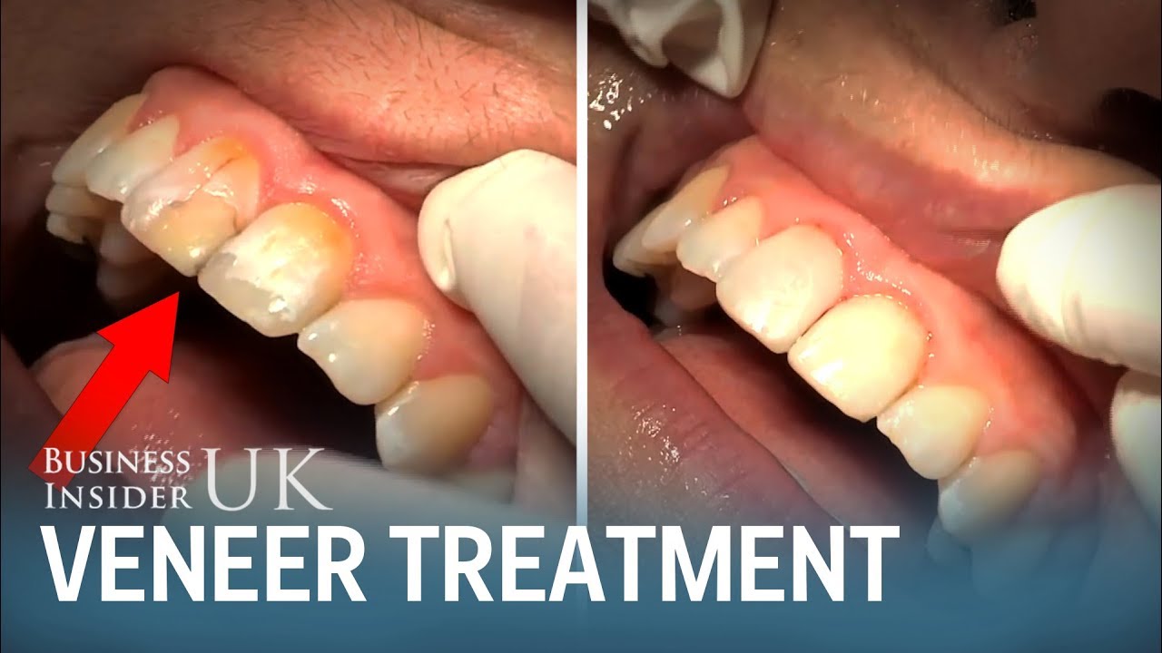 A dentist made a cheap alternative to porcelain veneers