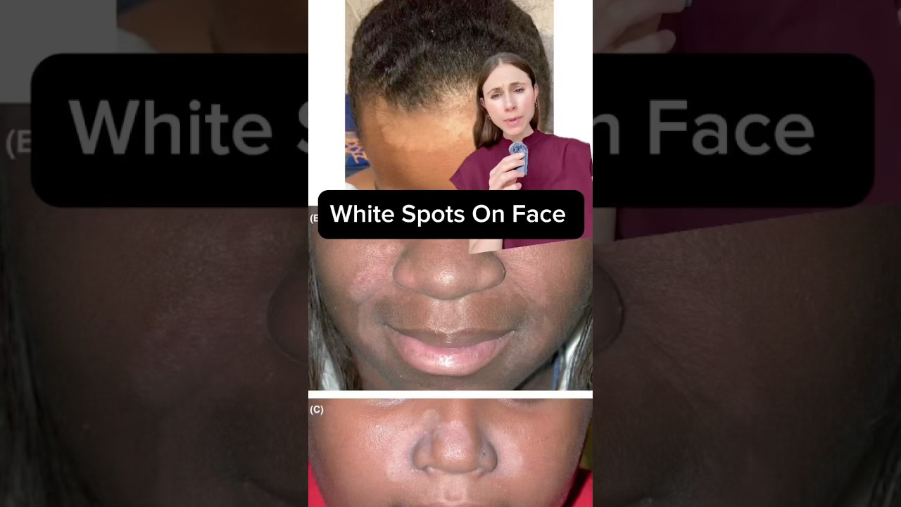 Dermatologists Reveal Best Way to Fix White Patches