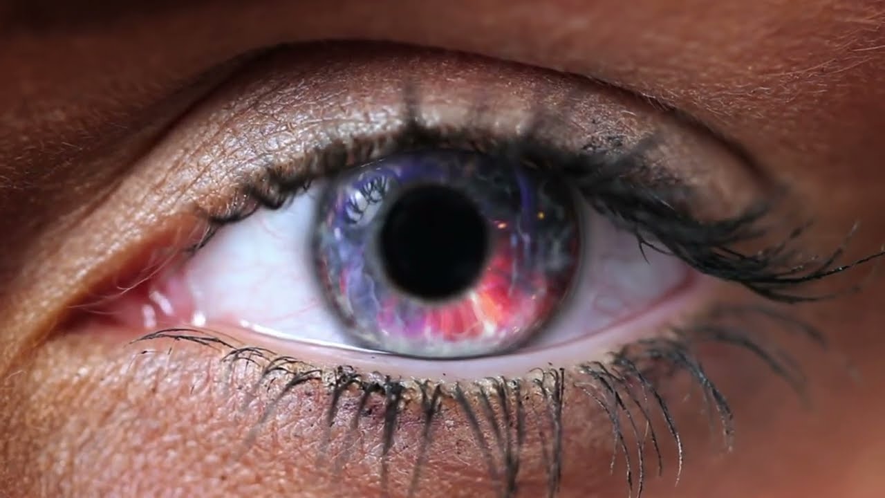 Kératocône  : Les anneaux intracornéens