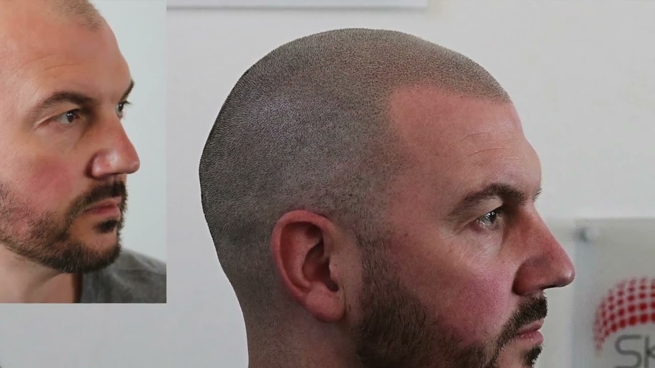 Skalptec our leading the way in, Hair Tattooing, SMP, Scalp Micropigmentation, best results of 2022